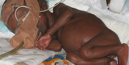 Premature Baby