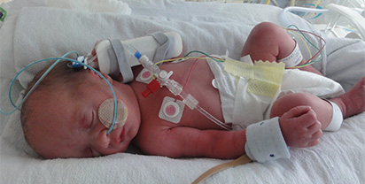 Premature Baby